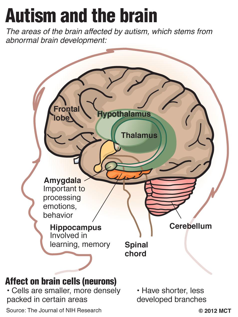 Brain disorder that makes it difficult to communicate Causes & Risk Factors Cause is not well