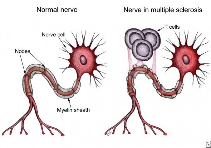 Autoimmune disease that damages the myelin sheath Causes & Risk Factors Cause not well understood Hereditary