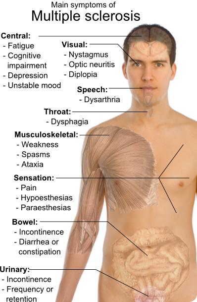 picture=symptoms_of_multiple_sclerosis.png B. http://probioticsnow.com/images/global%20ms.jpg C. http://www.