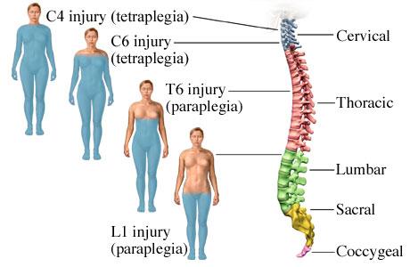 Damage to the spinal cord Causes & Risk Factors Symptoms Treatment Options Direct injury or disease