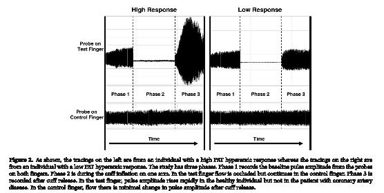 Figure 4. Data showing recordings from PAT showing endothelial response in subjects with (a) high hyperaemic response and (b) reduced hyperaemic response.