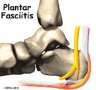 Introduction Plantar fasciitis is a painful condition affecting the bottom of the foot. It is a common cause of heel pain and is sometimes called a heel spur.
