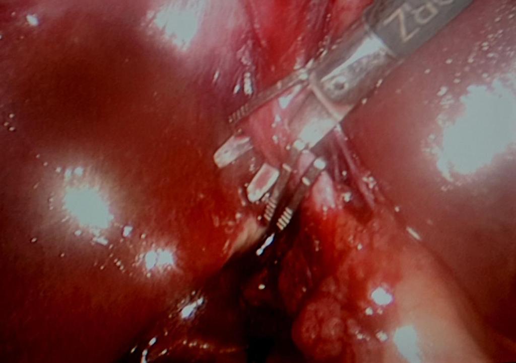 Figure 3: cystic duct clipped and ready to be cut, cystic artery seen at the back of scissor. References 1.
