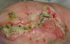 Wound Infection Abnormal granulation tissue Bleeding from friable granulation tissue Wound breakdown and enlargement Changes in color of the