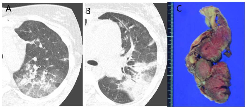 Initial coronal-reformatted CT image shows diffuse GGO (ground glass opacity) in both lungs with random distribution. B.