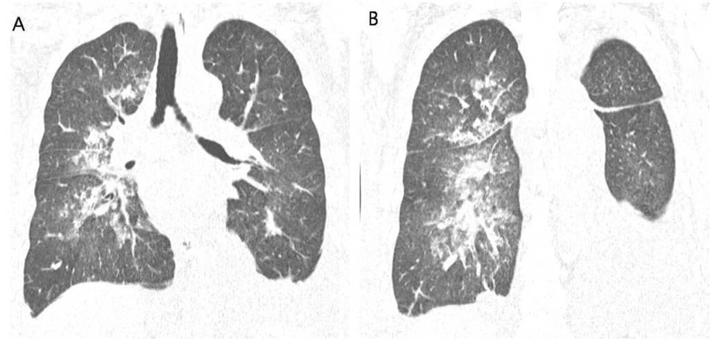 Fig. 7: A 49-year-old woman with systemic lupus erythematosus with diffuse pulmonary hemorrhage. A. B.