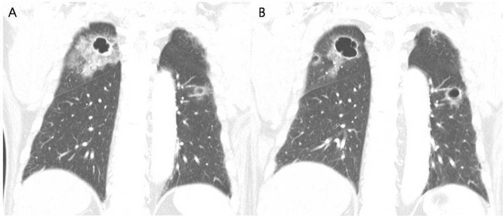 Consolidation and GGO were disappeared on follow-ct, rapidly (not shown). Fig.