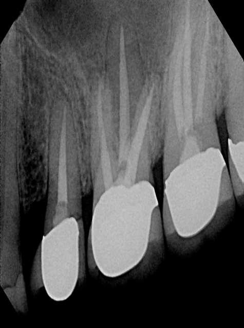 Teeth #13, 14 and 15 were endodontically treated by an