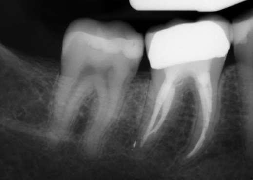 For root canal retreatments,