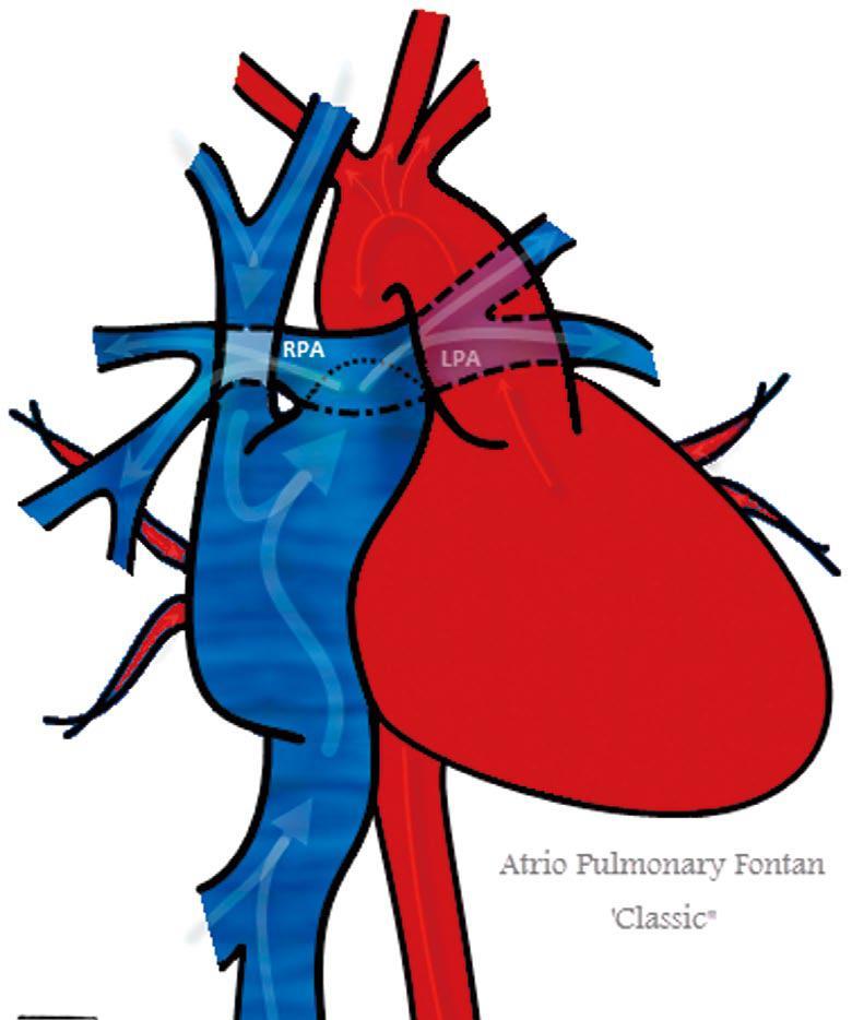 FONTAN CONCEPT Separate systemic & pulmonary flows: (a) connect systemic veins directly to pulmonary arteries (b) use single