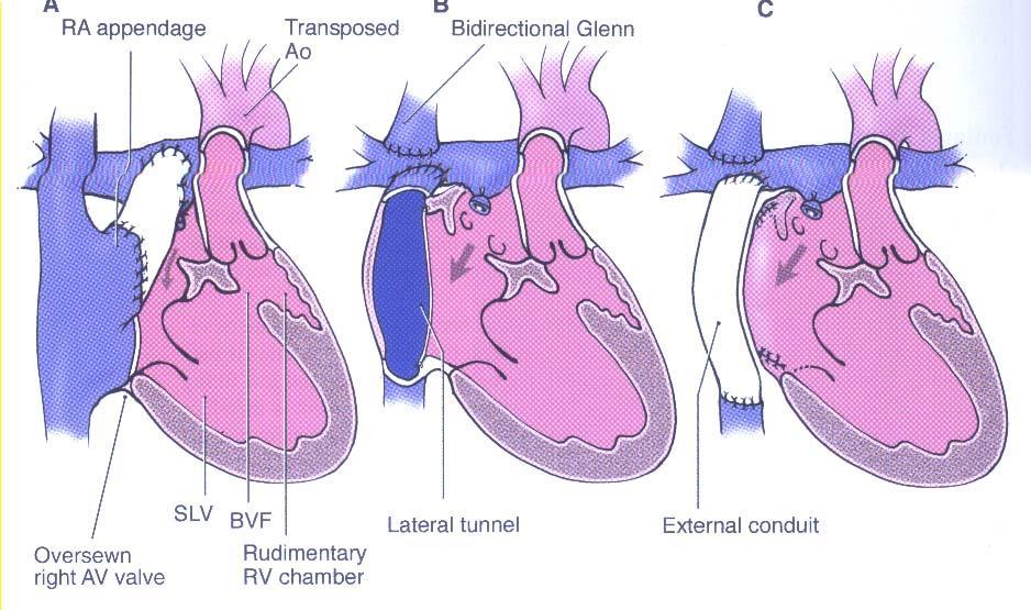 SINGLE VENTRICLE - Various types of Fontan operation