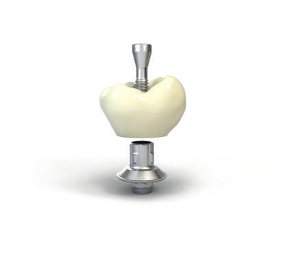 The cement line for the crown can also be optimally placed to ensure an easy cementation management and an ideal soft