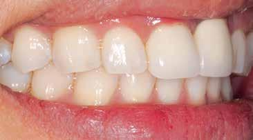 The condition of the gingiva suggested a possible base metal
