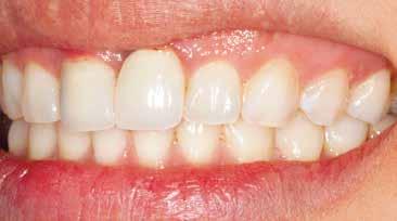 bi-layered restorations such as porcelain-fused-to-metal or