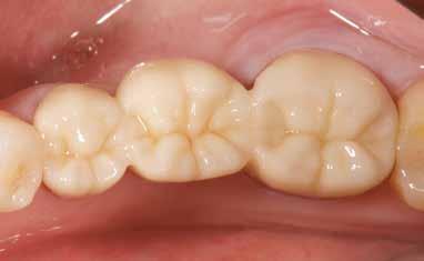 dentist prescribed after she fractured the porcelain on each of the abutment teeth on the