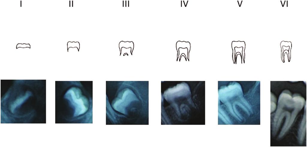 400 European Journal of Orthodontics, 2016, Vol. 38, No. 4 Figure 1. Representation of the calcification stages for molars (17).