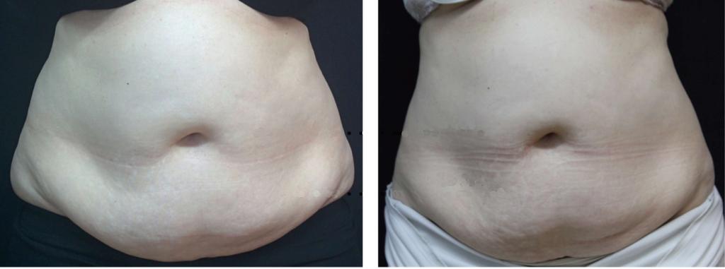 -8 cm -15 cm Before 4 wk after 8 treatments Figure 1 A 70-year-old female (body mass index 31) before and 4 wk after 8 treatment sessions (after), with 15 cm and 8 cm circumferential reduction