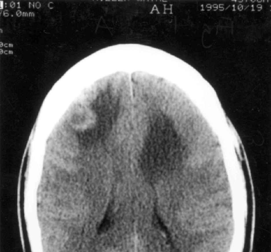 126 S. J. Rogers & J. S.Whelan grand mal seizures. CT of the head showed multiple metastases with considerable oedema (Fig. 1A,B).