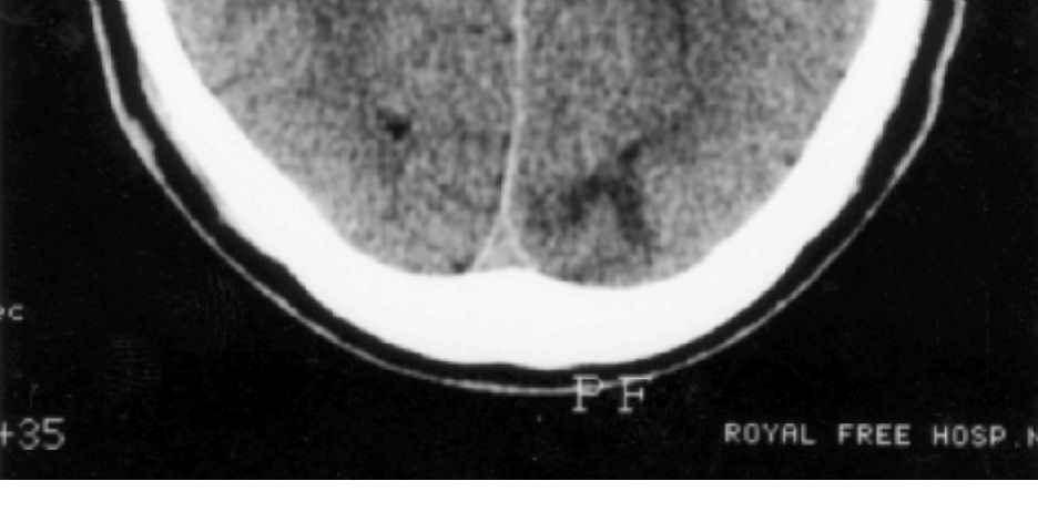 Patient 3 A 54-year-old female described an 18-month history of pain around the right knee, exacerbated by weight bearing.