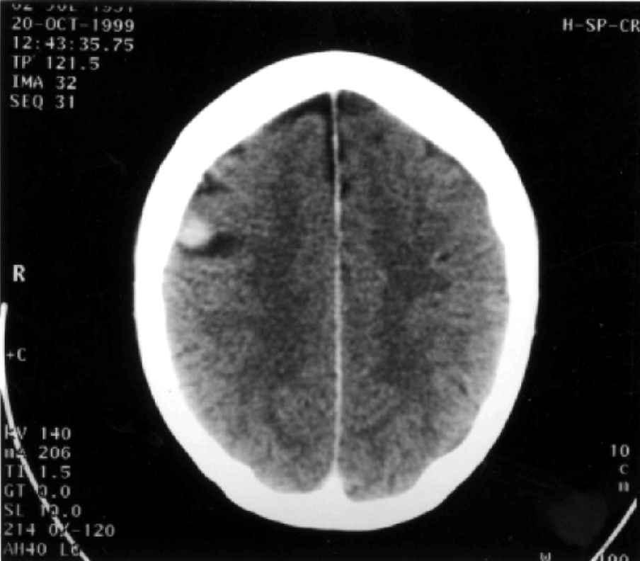 Cerebral metastases 127 preceding 6 months, presumed secondary to a groin strain, but had failed to respond to rest and analgesia.