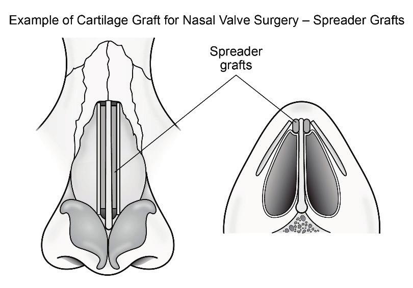 They can grow and block nasal breathing. Inferior Turbinate Reduction is a surgery done to remove the turbinates, make them smaller, or move them. This surgery improves the nasal airflow.