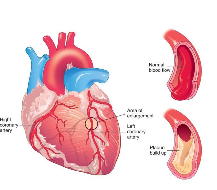 Coronary Heart Disease Coronary Heart Disease (CHD) - atherosclerosis of the coronary arteries, which can result in a heart attack CHD is the leading form of all cardiovascular diseases An