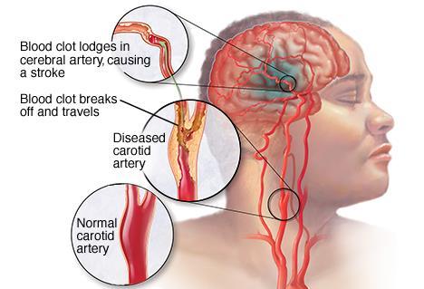 Stroke Ischemic Stroke - caused by blockage in a blood