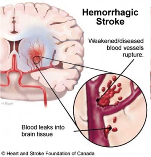 Stroke Hemorrhagic Stroke - caused by rupture of a blood
