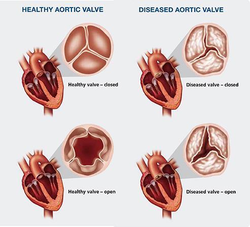 Other Cardiovascular Diseases Heart
