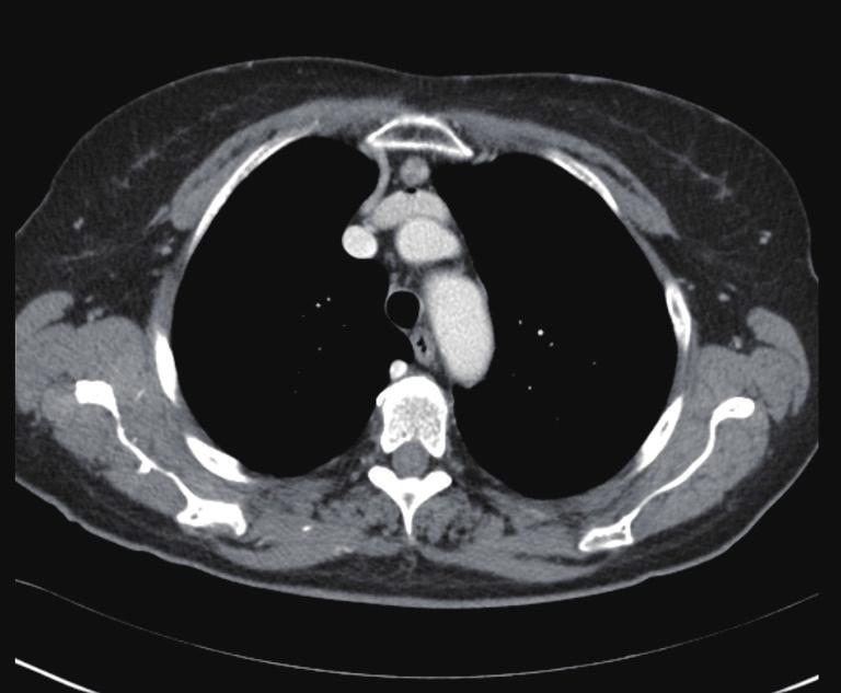 Shanghai Chest, 2018 Page 7 of 10 Figure 4 Chest CT-scan showing small centrally-located thymic tumor.