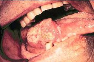 Oral Cancer Michael Finkelstein and Gilbert Lilly, University