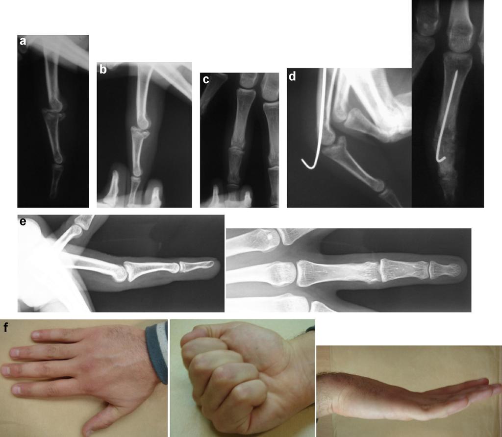 Extension-block pinning for fracture-dislocation of the interphalangeal joint 561 Figure 1 a: straight lateral x-ray of the fourth right finger showing a type III grade B, as reported by Trojan; b: