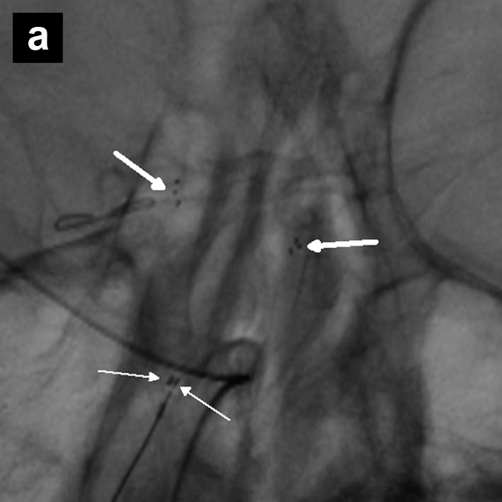 Case Report Y-stent assisted CE of wide-necked aneurysms Figure 2: (a) Post-deployment of both Solitaire AB TM stents to form the Y configuration.