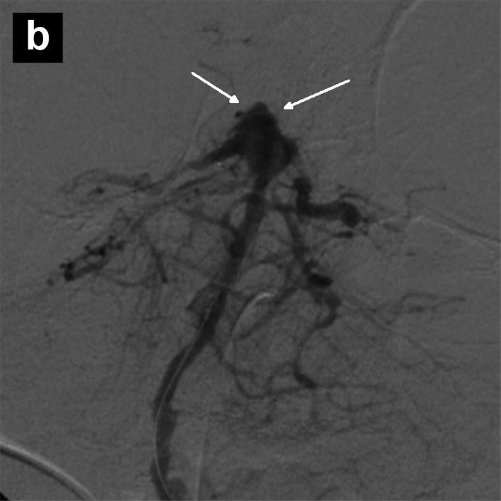 (b) Angiographic run post-deployment of Solitaire AB TM stents with no compromise of flow to the posterior circulation. The basilar tip aneurysm is visualised (white arrows).