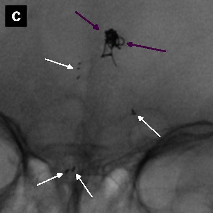 (d) Postembolisation angiographic run showing about a 50% obliteration of the basilar tip aneurysm (white arrows) with no compromise of flow to the posterior circulation. branch. A Leo stent (2.