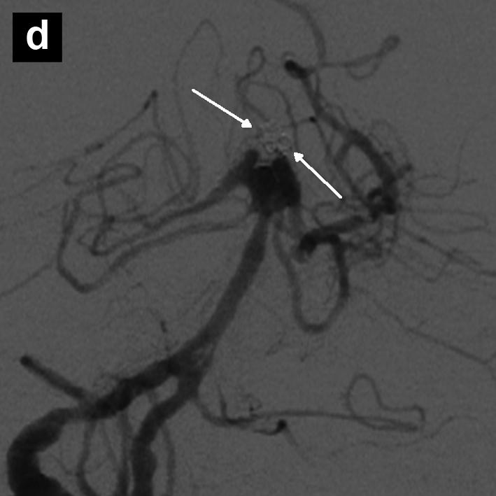 The aneurysm was loosely packed with 2 detachable coils that were deployed via an Excelsior SL 10 microcatheter (Boston Scientific, Fremont, CA) cannulated through the Solitaire AB TM stent struts