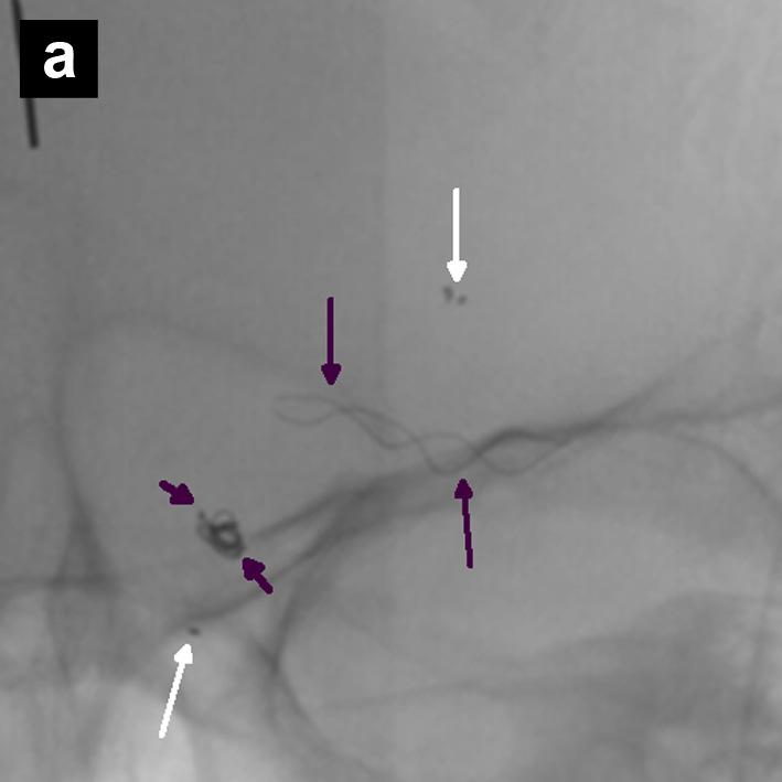 Malaysian J Med Sci. Oct-Dec 2011; 18(4): 91-97 Figure 3: (a) Post-deployment of Solitaire AB TM (white arrows) and Leo (long black arrows) stents to form the Y configuration.