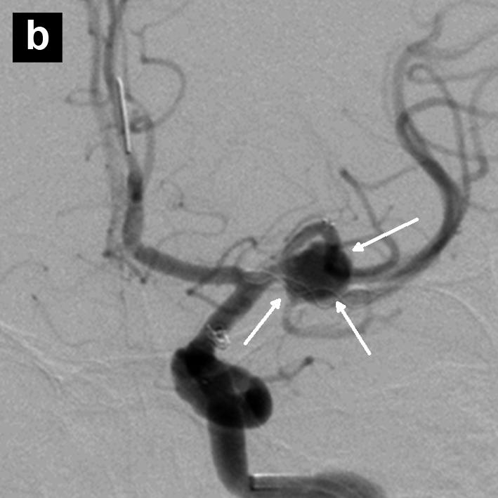(b) Angiographic run post-deployment of Solitaire AB TM and Leo stents with patency of both M2 branches. The MCA aneurysm is visualised (white arrows).