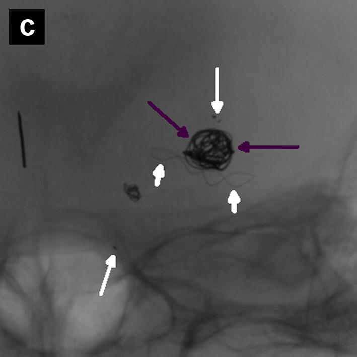 (d) Post-embolisation angiographic run showing about a 50% obliteration of the MCA aneurysm (white arrows) with patency of both M2 branches.