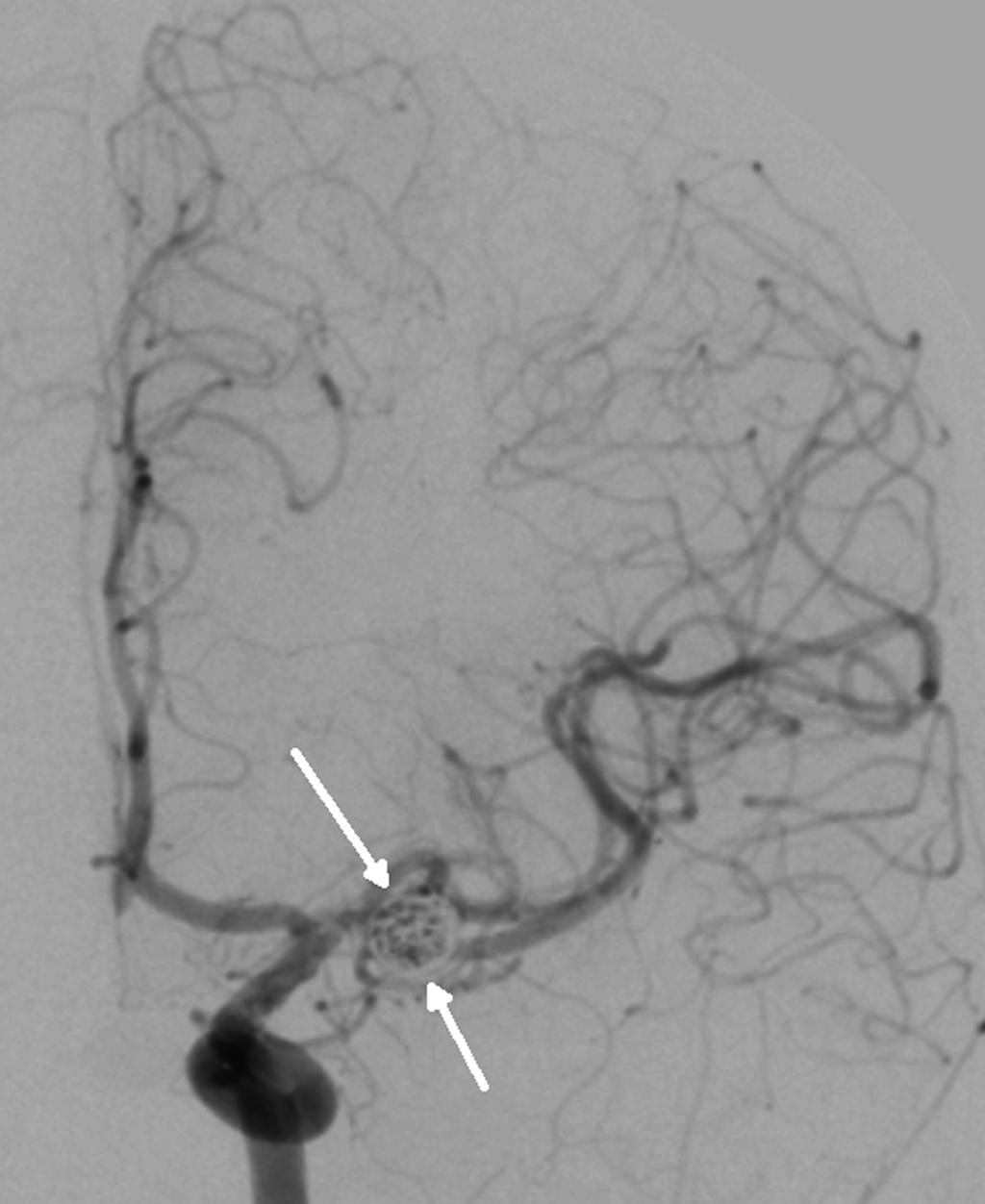 Case Report Y-stent assisted CE of wide-necked aneurysms Figure 4: Left internal carotid angiogram 3 months post-embolisation showing only about 30% of the MCA aneurysm opacified with patency of both