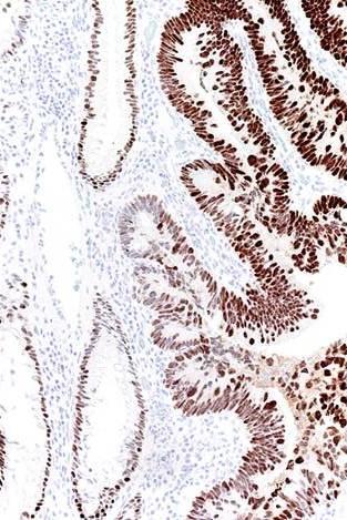 CDX-2 protein in adenocarcinoma Colorectum +( ) Mucinous ovar. +( ) Esoph./Stom.