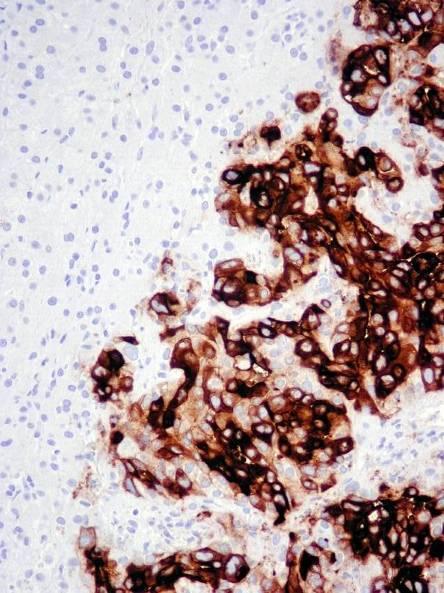 Carcinoembryonic antigen (CD66e) in adenocarcinomas Colorectal + Medull.