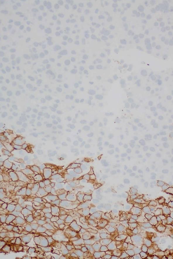 Glypican 3 Hepatocellular carcinoma +/- Yolk sac tumour + Chorionic carcinoma + Merkel cell carcinoma +/- Colorectal adenocarcinoma