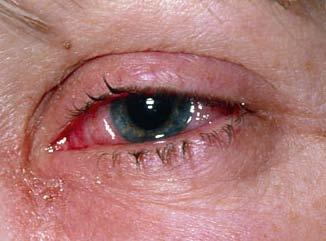 Typical Health Threats Due to Indoor Air Quality Red Eyes Red eyes often are referred to as "allergy eyes," given that eye redness is a common indicator of an allergic reaction.