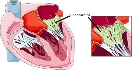 Infective Endocarditis (IE) Infection caused by bacteria that enter bloodstream and settle the lining of the
