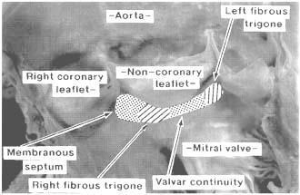 aortomitral continuity