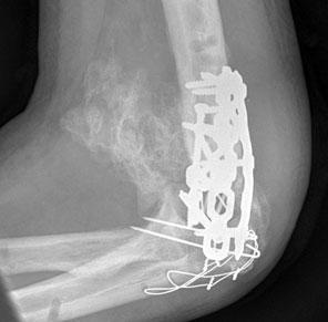 Operative exploration disclosed fracture of the lateral epicondyle and avulsion of the medial