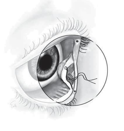 RESULTS Caruncle Edge of Conjunctiva Medial Orbit Figure 7. Completed precaruncular approach to the medial orbit. The caruncle and adjacent conjunctiva are retracted laterally.