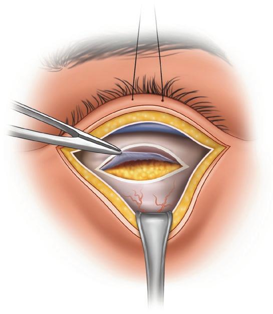 2 Entropion made 2 mm below the lash line from below the punctum to the lateral canthal angle.