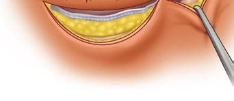 Local anesthesia is administered to the eyelid, and a horizontal incision is made 4 mm from the lid through skin and orbicularis.